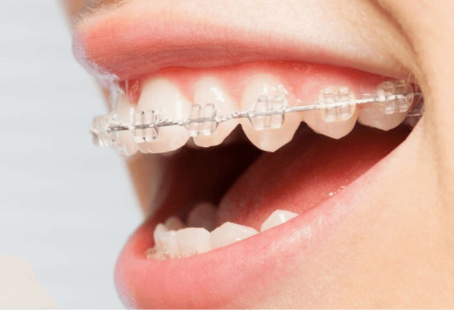 aparelho dentario ceramica